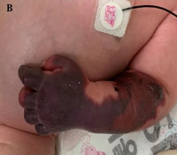 Ауыр туа біткен С протеинінің тапшылығы