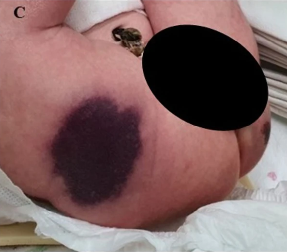 Ауыр туа біткен С протеинінің тапшылығы