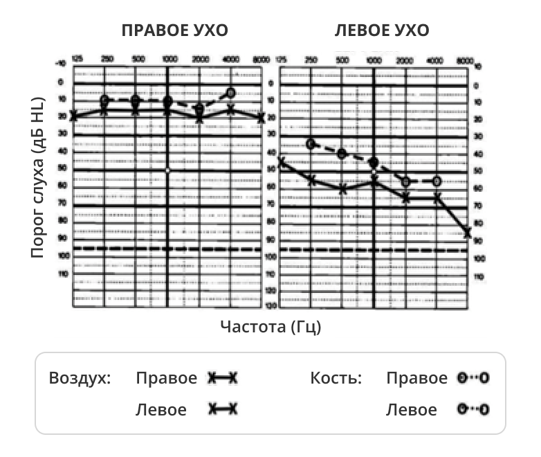 Тональная пороговая аудиограмма при кохлеовестибулярных нарушениях
