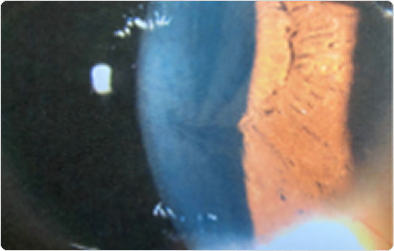 Фотография роговицы с cornea verticillata при болезни Фабри