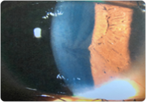 Фотография роговицы с cornea verticillata при болезни Фабри